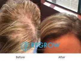 ReGrow- Hair restoration  888-897-5899