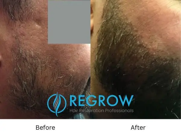 ReGrow- Hair restoration  888-897-5899
